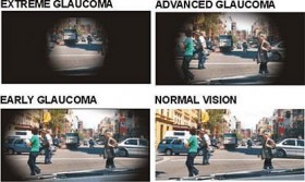 Che cos'è il Glaucoma? - Studio Oculistico Aiello